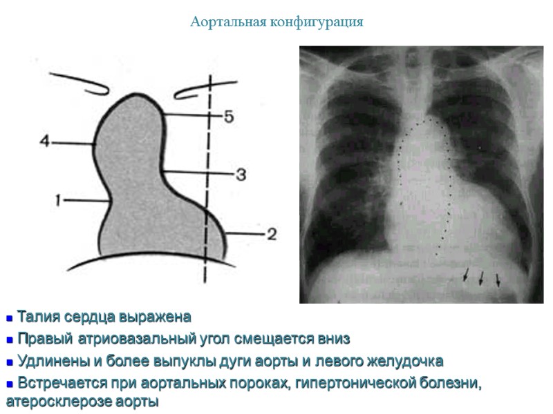 Аортальная конфигурация  Талия сердца выражена  Правый атриовазальный угол смещается вниз  Удлинены